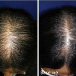 How to Reverse Thinning Hair After Menopause: An Expert Guide